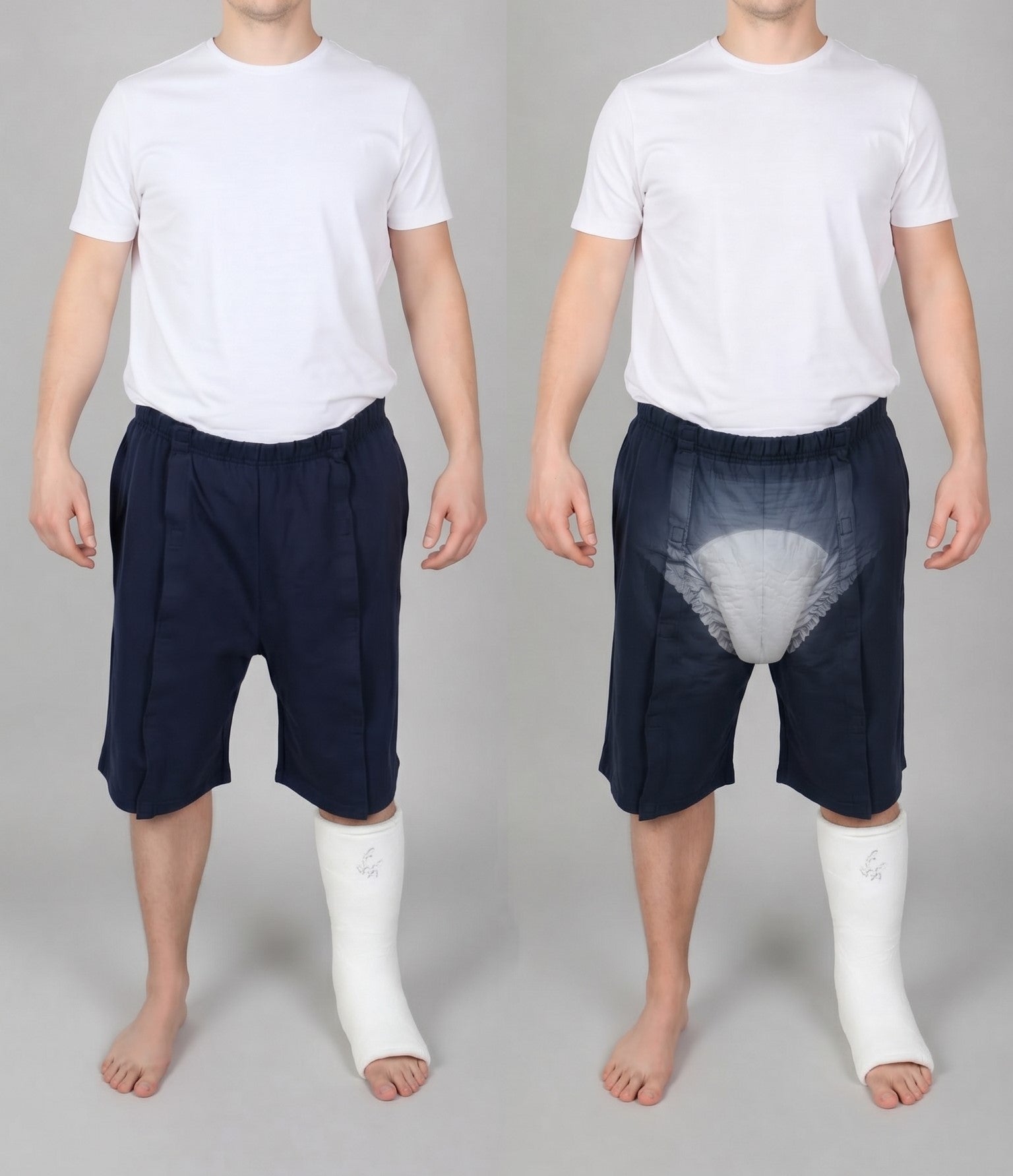 ComfortCure Adaptive Pflegeshorts für bettlägerige Patienten - Klettverschluss, vorne komplett zu öffnen, Navy, Vergleich Vorderansicht mit Gips und transparenter Vorlage